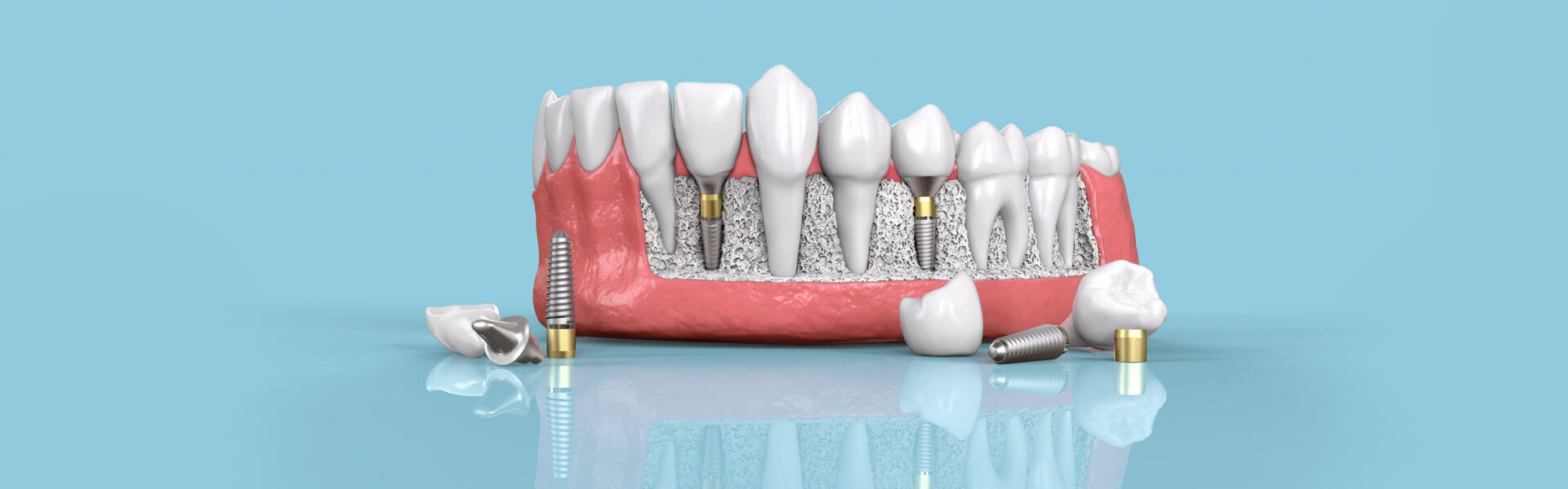 Dental Implants in Largo, FL